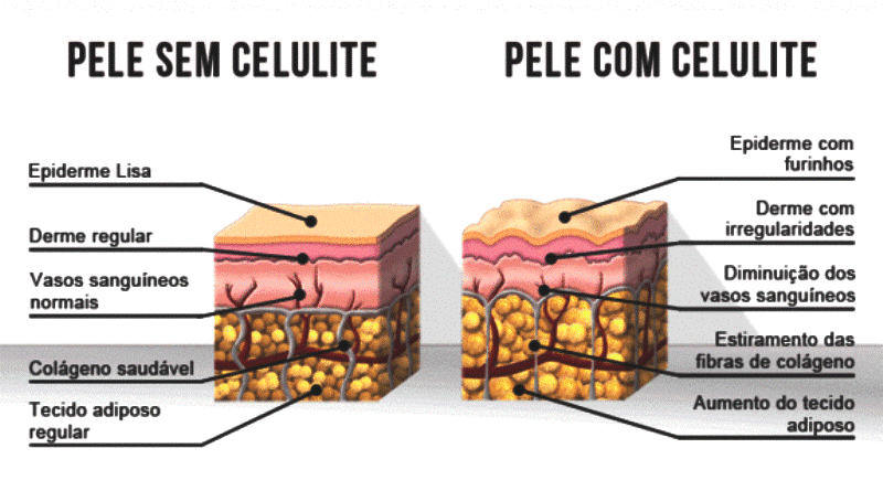 graus-da-celulite